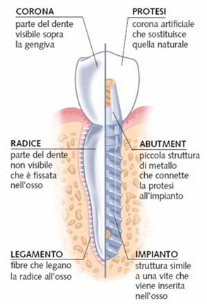 impianti dentali